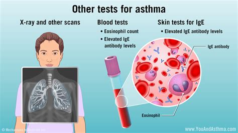 x ray for asthma|Asthma: Steps in testing and diagnosis .